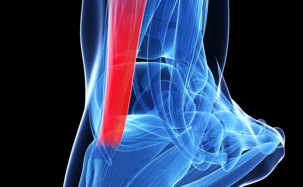 Heel Pain After Running: Causes, Treatment, Prevention