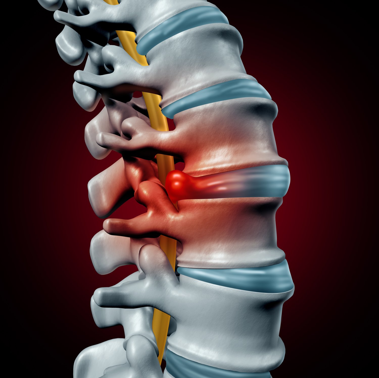 How to protect yourself from pain with a “Slipped Disc” HCRC