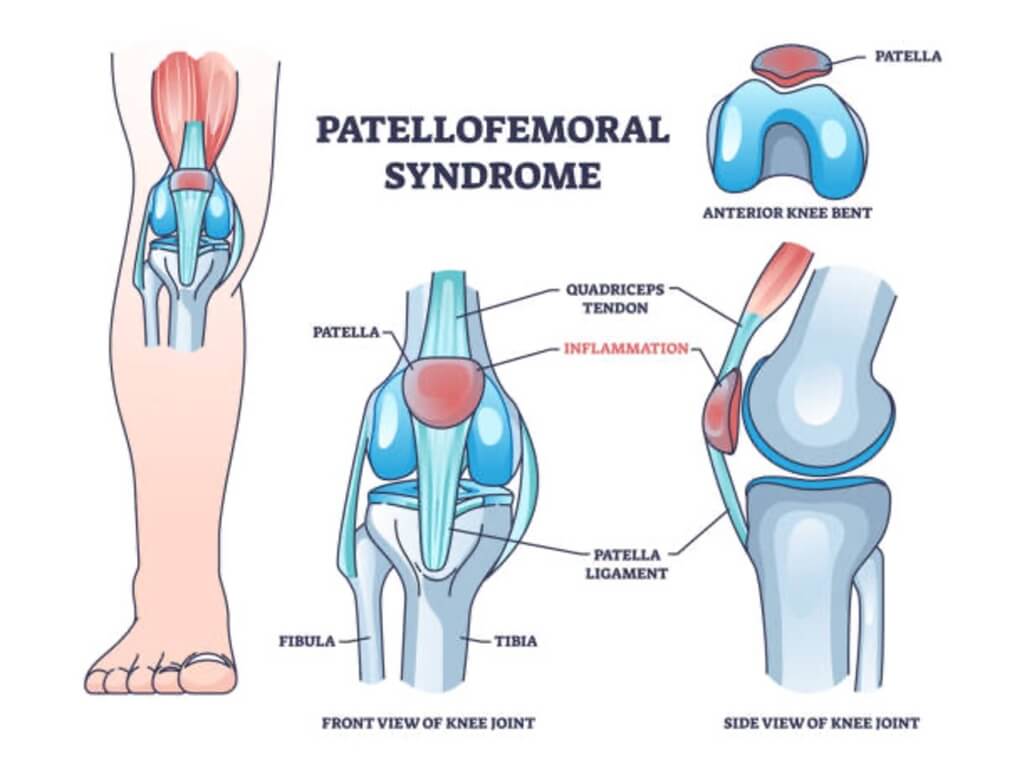 Runners Knee - What causes and treatments