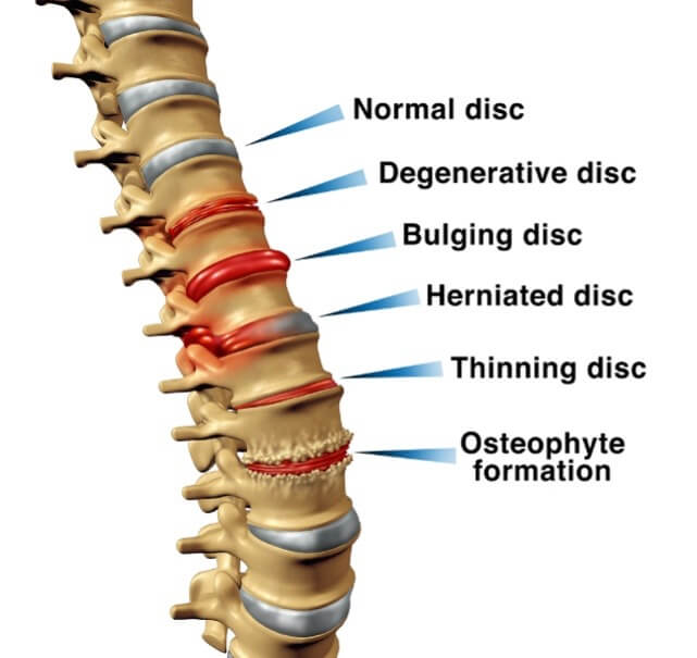 Spinal Disc Inflammation causing back pain
